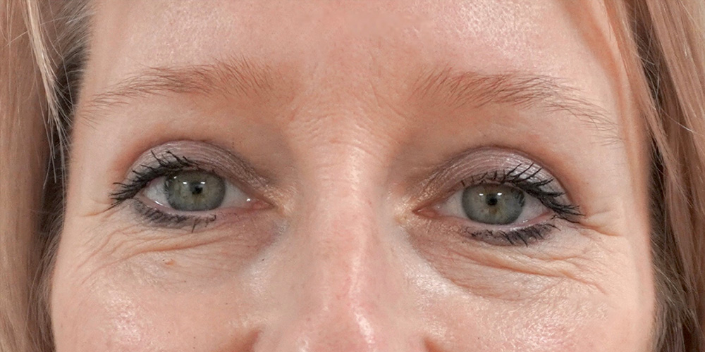 ooglidcorrectie na operatie